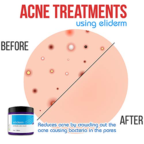Topical Probiotic Skin Cream - 4OZ Jar 13 Strain Moisturizing Probiotic Lotion Eczema Treatment Psoriasis Treatment for Cystic Acne Probiotic Skin Care Cream Nail Fungus Treatment