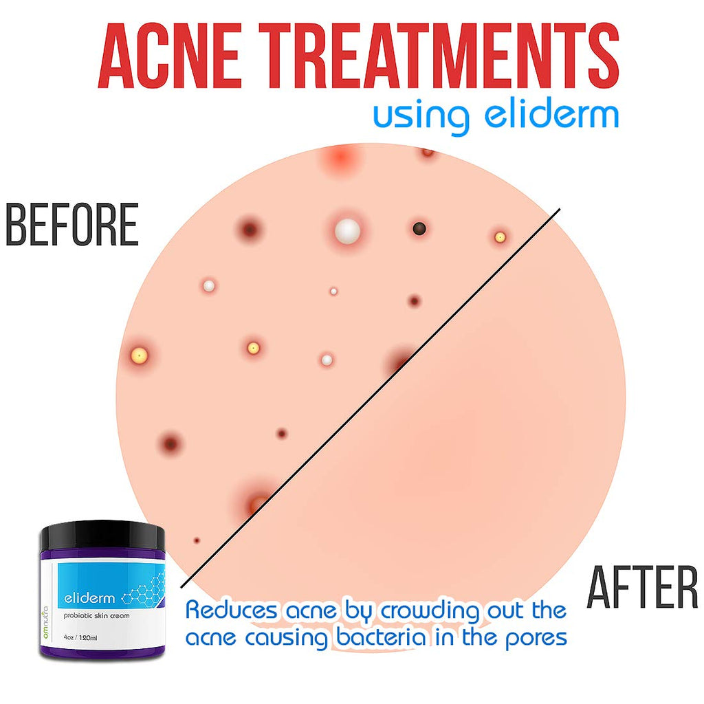 Topical Probiotic Skin Cream - 4OZ Jar 13 Strain Moisturizing Probiotic Lotion Eczema Treatment Psoriasis Treatment for Cystic Acne Probiotic Skin Care Cream Nail Fungus Treatment